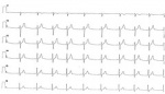EKG Andy Ciordia